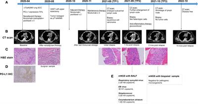 Case report: Spontaneous remission in lung carcinoma with a late relapse after adjuvant immunotherapy: Exceptional tumor micro-environment
